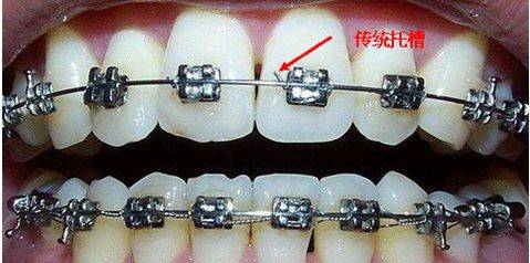 矫正过程中托槽掉下来该怎么办 不按医生要求挂橡皮圈可以吗