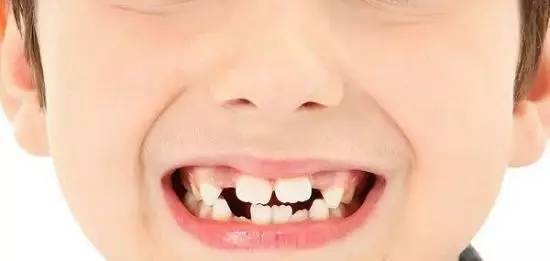 “老虎牙”突出来可以拔掉吗 孩子长了“双排牙”该怎么办