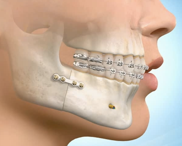 牙齿矫正会伤害牙神经吗 牙齿矫正后会出现“牙套脸”吗