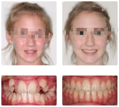 儿童矫正牙齿越早越好吗