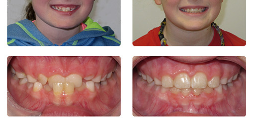 儿童乳牙“地包天”需要矫治吗 儿童下颌后缩需要早期矫正吗