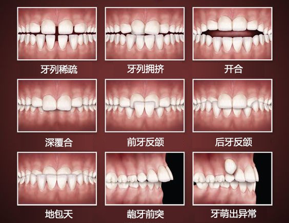 牙颌畸形有什么危害