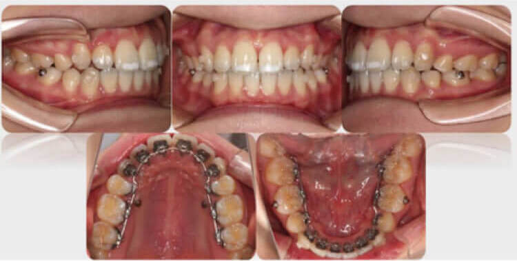 什么是舌侧矫治 舌侧矫治有什么优点和缺点