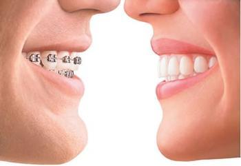成人牙齿矫正有什么特点