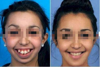 矫正牙齿可以瘦脸吗