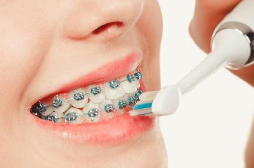 矫正牙齿期间怎样选择牙刷 怎样正确有效地刷牙