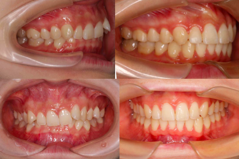 矫正拔牙会留下牙缝吗 会影响健康吗