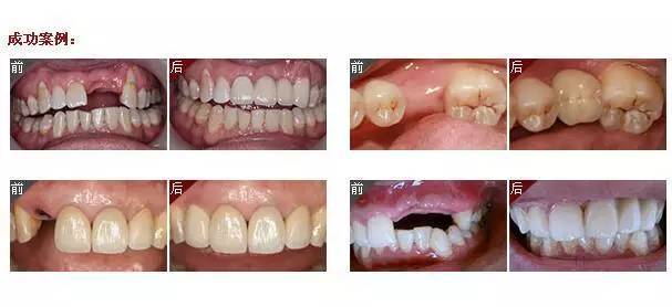 缺牙对身体有何不良影响