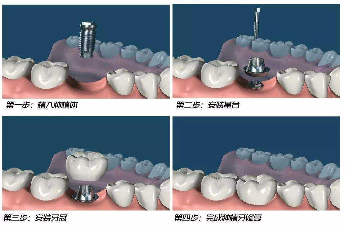 种植牙如何维护