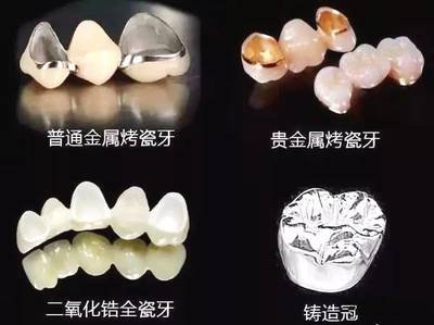 什么是瓷牙 分别有什么种类