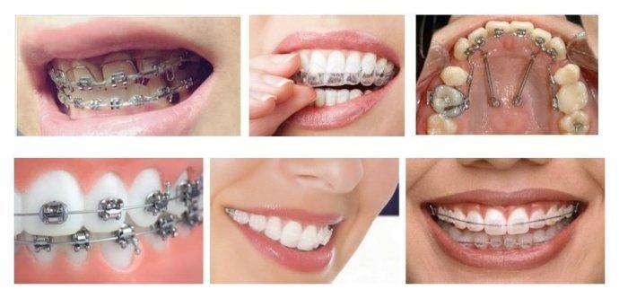 什么是正畸矫治器 它有哪些种类
