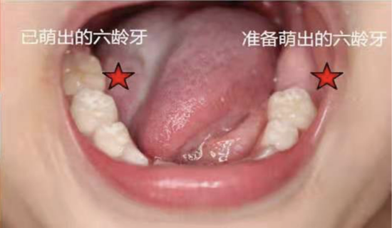 什么是“六龄齿" 如何保护“六龄齿"