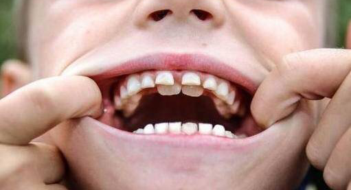 宝宝为什么会长双层牙 该怎么办