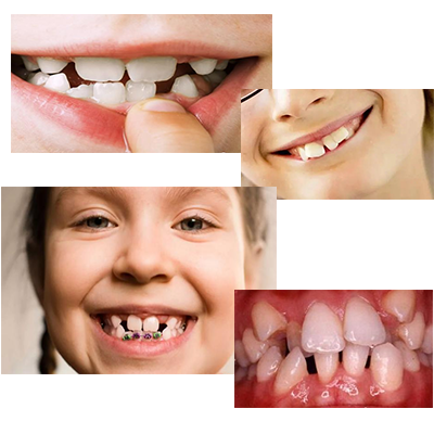 儿童什么时候矫正牙齿比较好