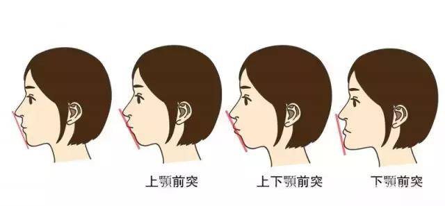矫正牙齿对容貌的影响有多大