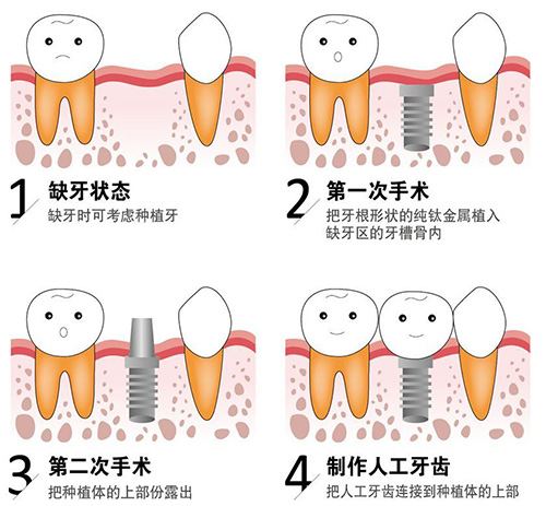 种植牙的治疗过程