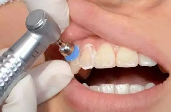 牙齿美白的方法有哪些