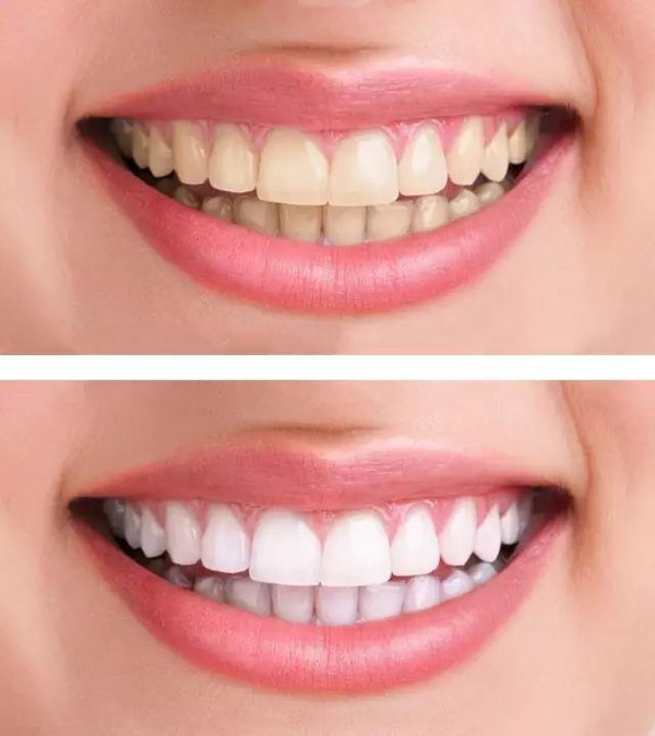 常见的牙齿变色的原因