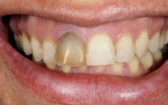 死髓牙为什么也会痛