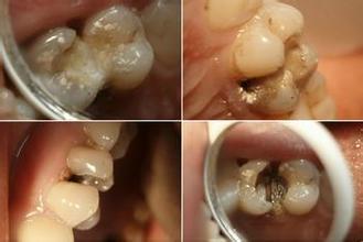 牙髓炎有哪些危害