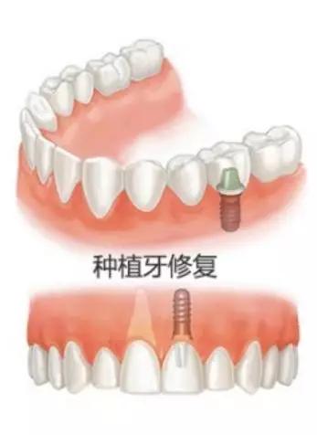 做完种植牙治疗后为什么要定期复查 种植牙能使用多久