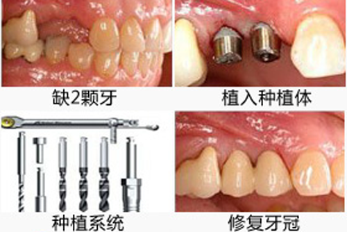 你是不是对种植牙有误解
