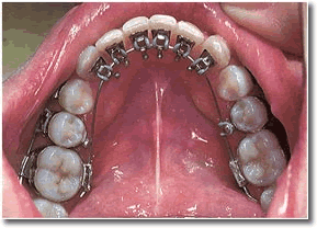 成人舌侧正畸中的牙周问题