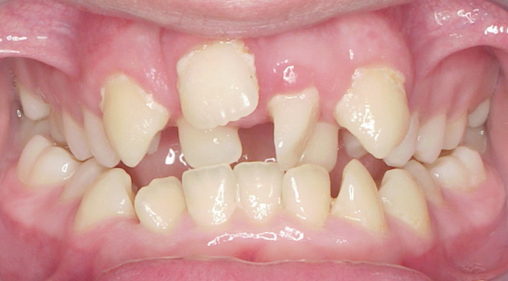 阻生牙常见的有哪几种情况 阻生牙的阻生类型有什么