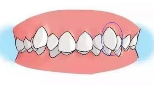 儿童为什么会长“虎牙” 长了“虎牙”是否就应该拔掉吗