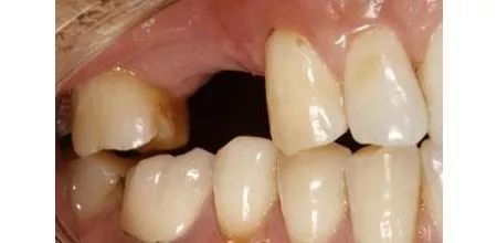 缺牙后长期不镶牙会发生什么样的后果