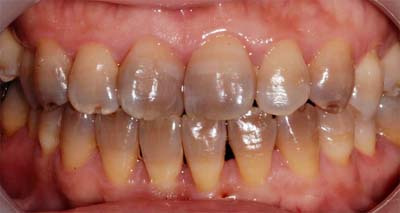 什么是四环素牙 治疗四环素牙的原则是什么