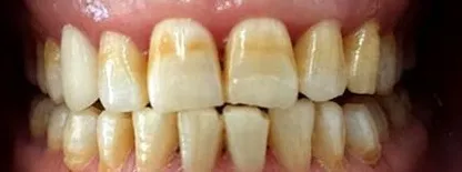 什么是氟牙症 氟牙症的防治原则是什么