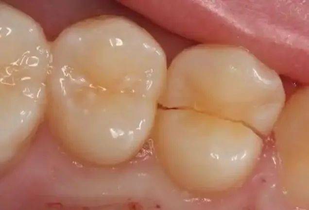 什么叫牙隐裂 有何症状 牙隐裂治疗的原则是什么