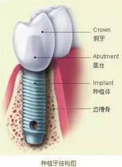种植体的结构包括什么 种植体的材料是什么