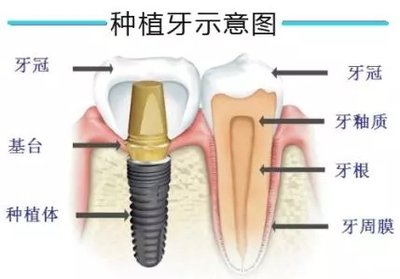 种植牙有什么禁忌症 