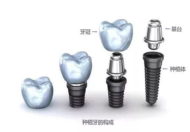 种植体是什么样的 种植体的材料有哪些