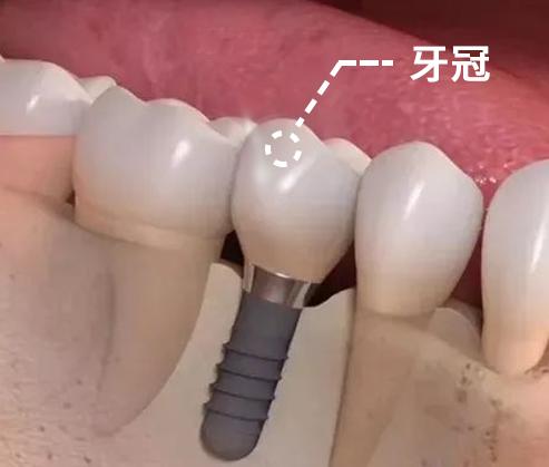 种植牙牙冠的材料有哪些 全瓷冠有哪些优点