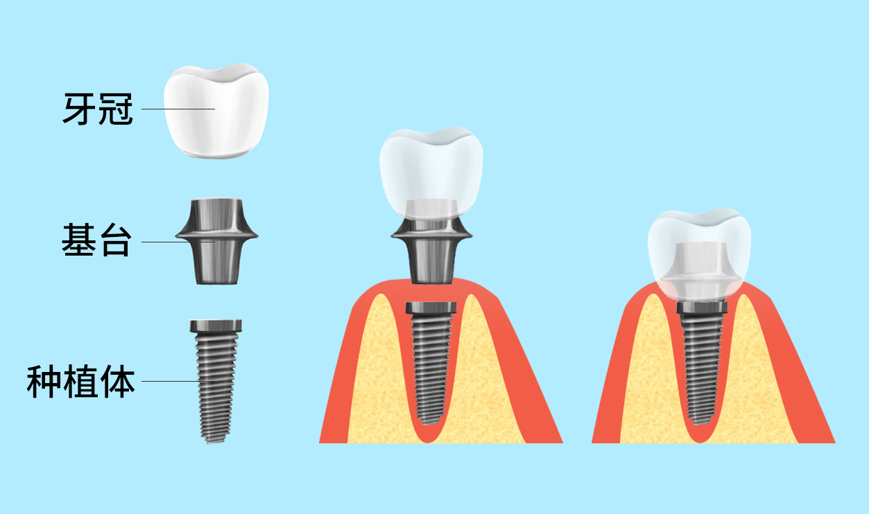 种植牙术前有哪些注意事项 种植牙术前健康调查表是什么样的