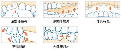 缺牙时间太久能种植牙吗 种植牙植骨的材料是什么