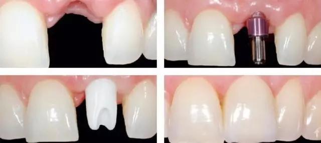 种植牙术后有什么并发症