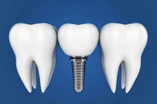 种植牙种好了以后该怎么保养