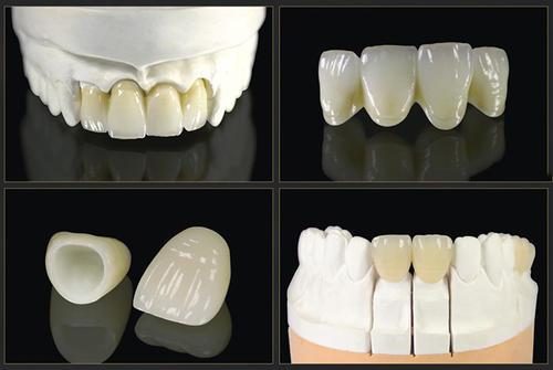 全瓷冠有哪些适应证和禁忌症 全瓷冠有哪些注意事项