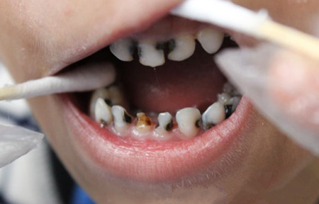 儿童龋齿的原因是什么 儿童龋齿怎么预防
