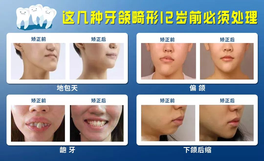 哪些儿童牙颌畸形必须早期矫治