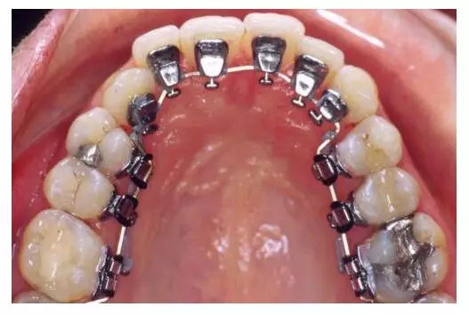 舌侧矫治中的流程是什么样的