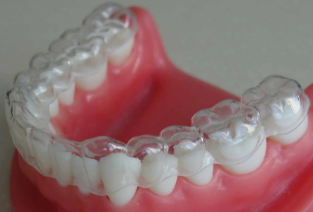 隐形矫治的过程是什么样的