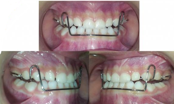 什么是功能性矫治器 功能性矫治器的作用是什么