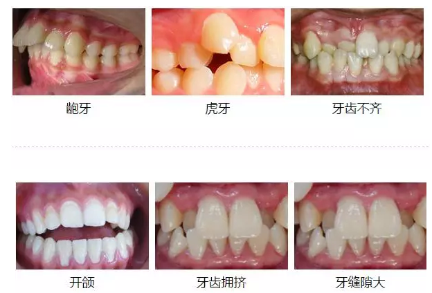 什么是早期治疗 牙性开颌和骨性开颌有什么不同