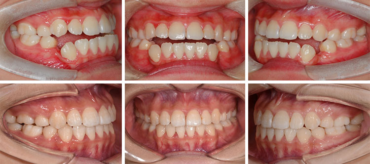 骨性开颌的治疗过程是怎么样的