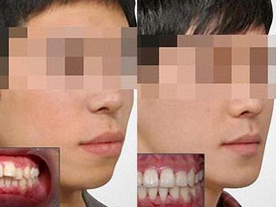 哪些牙颌畸形是需要结合正颌外科手术正畸的